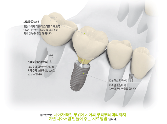 dentium_pr_implantguide_what_01
