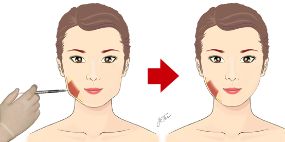 nosurg